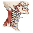 Cervical Disc Arthroplasty (CDA)