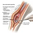 Cyst Curettage + Bone Graft/Bone Substitute