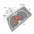 CT-guided Radiofrequency Ablation (RFA)