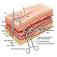 Surgical Ligation/Division