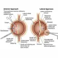 Anterior/Lateral Orbitotomy En Bloc Resection