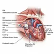 Permanent Pacemaker Implantation