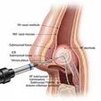 Inferior Turbinate Plasty/Radiofrequency Ablation