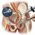 Hip Arthroscopic Labral Reconstruction
