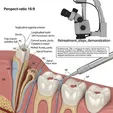 Endodontic Retreatment - Removal of Old Filling and Re-preparation under Microscope