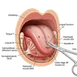 Frenotomy