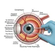 Anterior Lamellar Keratoplasty