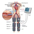 Enhanced External Counterpulsation (EECP)