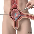 Transurethral Cyst Fenestration/Incision