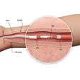 Microsuture