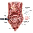 Transurethral Resection/Reconstruction of Ejaculatory Ducts (TURED)