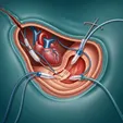 Surgical Atrial Septal Defect Repair