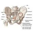 Pelvic Osteotomy (Salter et al.)