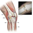 Arthroscopic Debridement/Microfracture