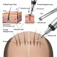 Hair Transplantation FUE/FUT