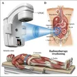 Radiation Therapy