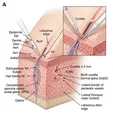 Axillary Sweat Gland Curettage/Suction Curettage