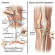 Fibular Neck Decompression