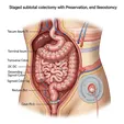 Subtotal Colectomy + Ileostomy