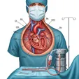Open Surgical Repair of Ventricular Septal Defect with Cardiopulmonary Bypass