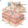 Excision + Postoperative Superficial Radiation Therapy