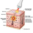 Intense Pulsed Light (IPL) Therapy