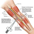 Endoscopic Ulnar Nerve Release