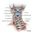 Anterior Cervical Discectomy and Fusion (ACDF)
