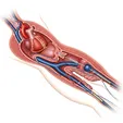 Percutaneous Balloon Mitral Valvuloplasty (PBMV/PMC)