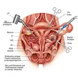 Pelvic Lesion Excision + Adhesiolysis