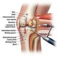 Endoscopically Assisted Osteochondroma Resection