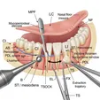 Supernumerary Tooth Extraction