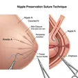 Inverted Nipple Correction
