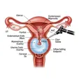 Hysteroscopic Polypectomy