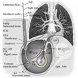 Hydrocele Aspiration + Sclerotherapy