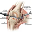 Arthroscopic Knee Chondroplasty/Microfracture