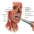 Branchial Cleft Cyst/Fistula Excision ± Internal Opening Management