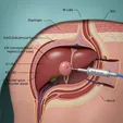 Ablation