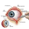 Conjunctival Mass Excision + Cryotherapy + Amniotic Membrane Transplantation