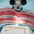 Microsurgical Varicocelectomy